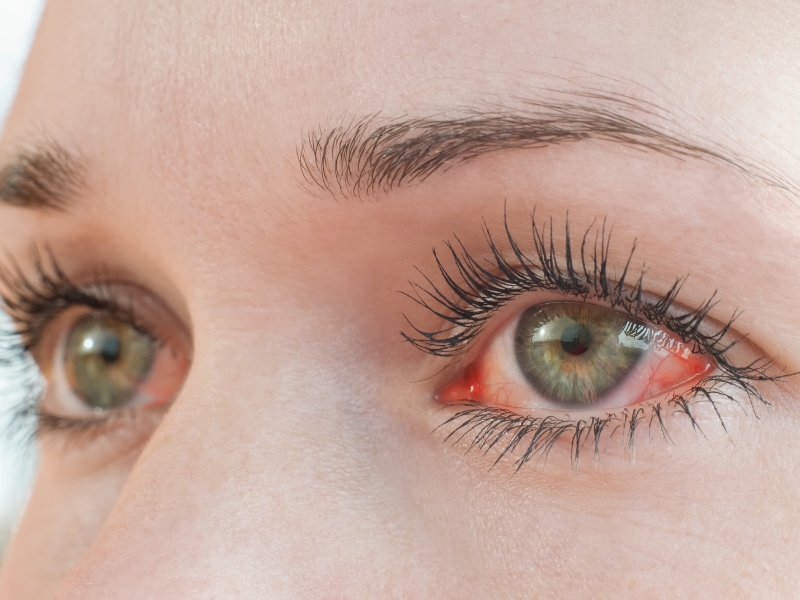 dores de cabeça e olhos vermelhos​